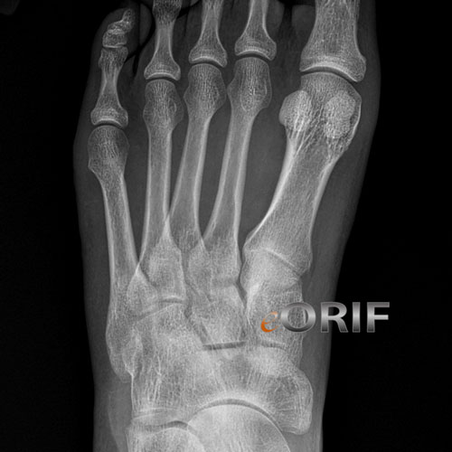 Metatarsal stress fracture