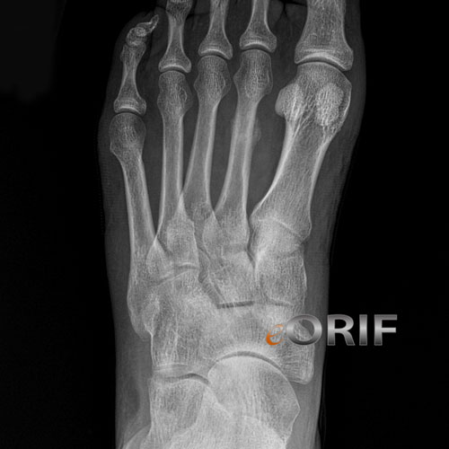 Metatarsal stress fracture 6 weeks