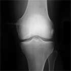 knee ocd xray