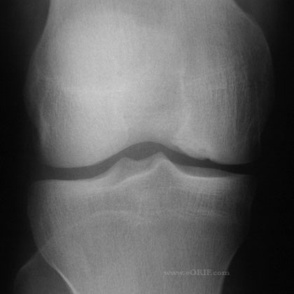 knee ocd xray