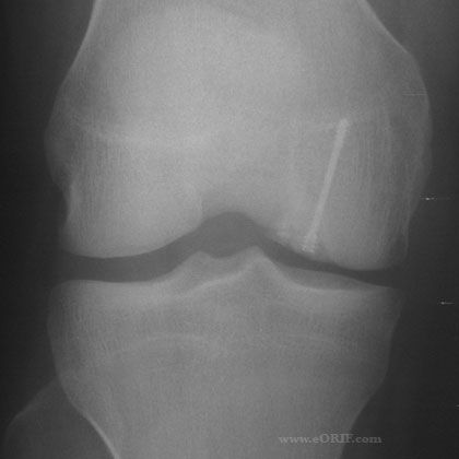 ORIF knee ocd xray