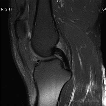 Normal PCL MRI image