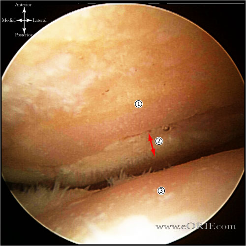 Patellofemoral arthritis image