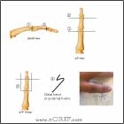 PIP joint external fixation