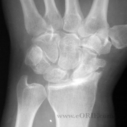 Stage II SLAC wrist xray