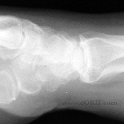 Stage II SLAC wrist xray