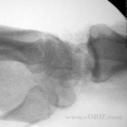 proximal row carpectomy xray