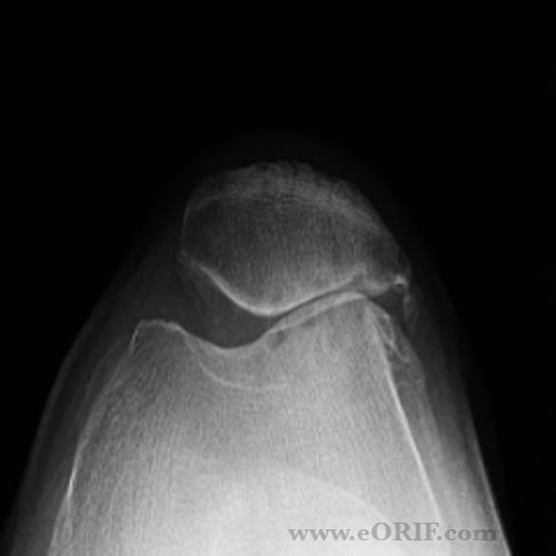 Patellofemoral arthritis xray