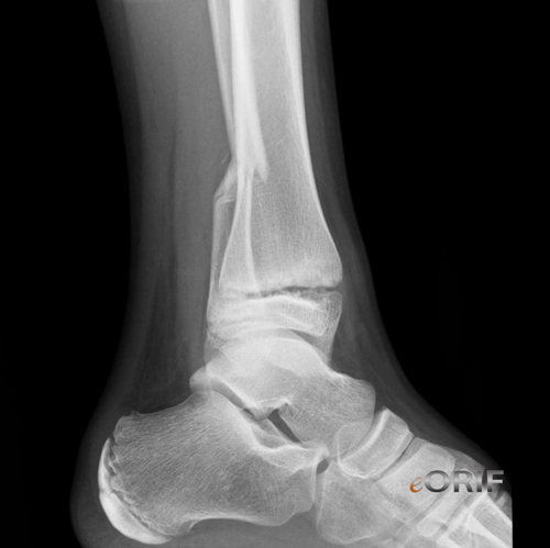 pediatric distal tibia fracture xray