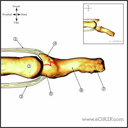 boney mallet finger