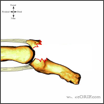 distal plalanx mallet fracture