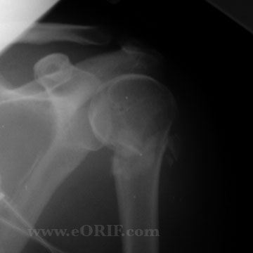 Proximal Humerus Fracture xray