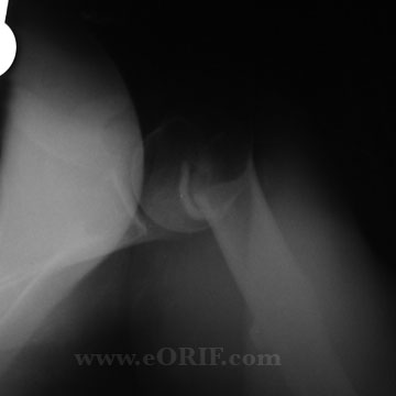 Proximal Humerus Fracture xray