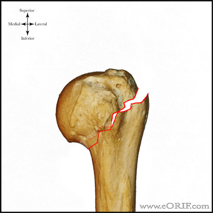 Type A2 proximal humerus fracture