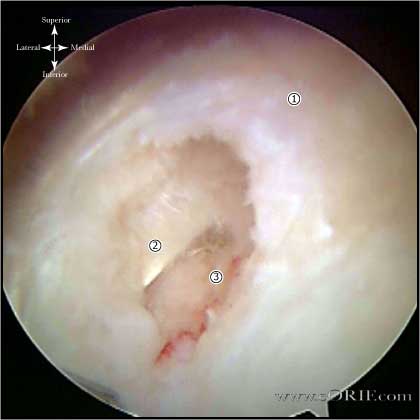 U-shaped rotator cuff tear