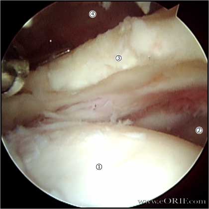 Massive rotator cuff tear