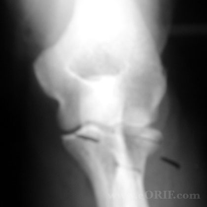 Type III Radial head fracture xray