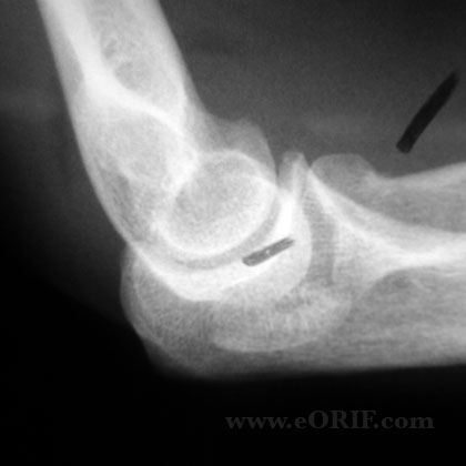 Type III Radial head fracture