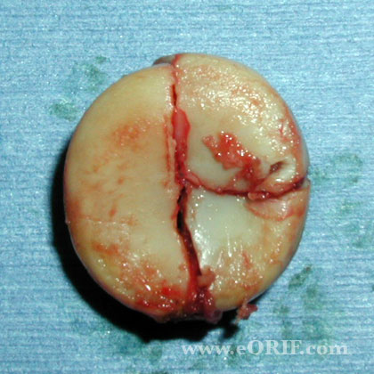 Radial Head Fracture Comminution image