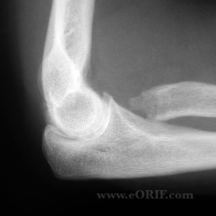 Radial head excision xray