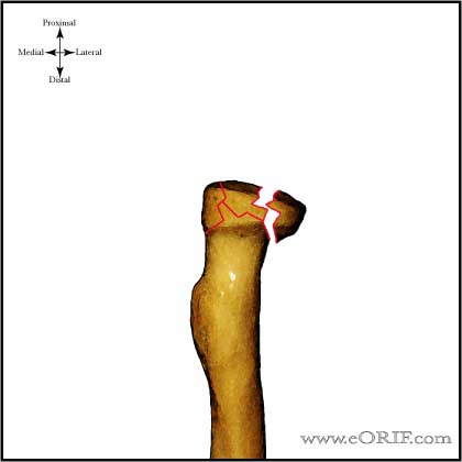 Type III Radial head fracture