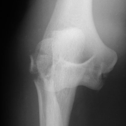 Mason Type IV radial head fracture xray