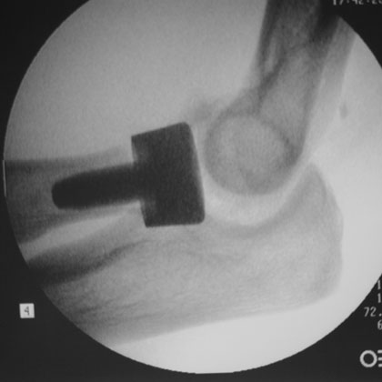 Radial Head arthroplasty xray