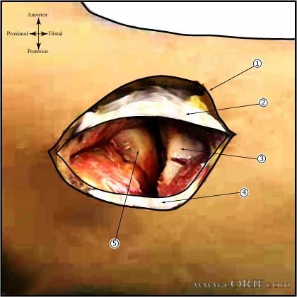 Elbow surgical approaches