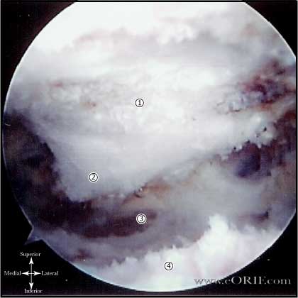 Type III acromion picture