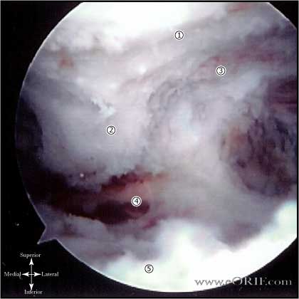 acromial spur