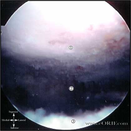 Arthroscopic subacromial decompression