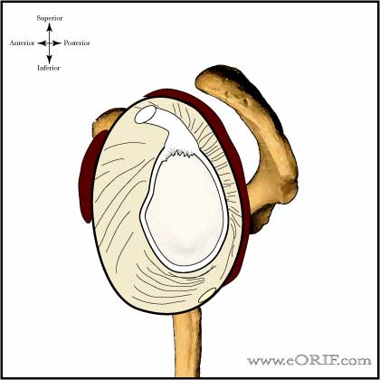 Type I SLAP tear