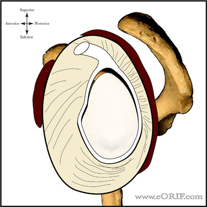 Type II SLAP Tear picture