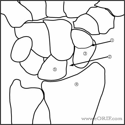 Wrist instability image