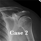 shoulder osteoarthritis xray