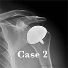 shoulder resurfacing hemiarthroplasty