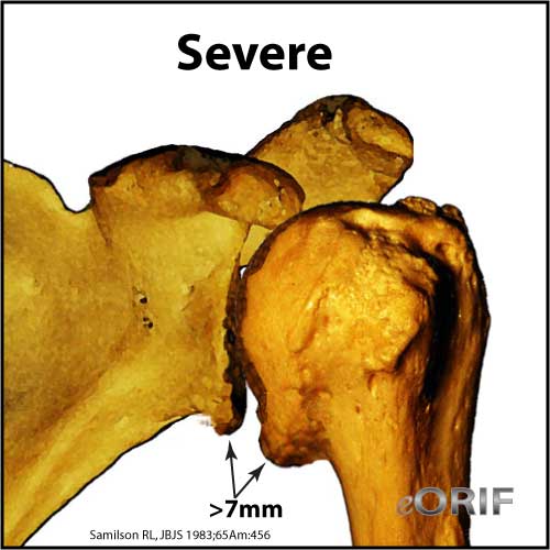 Shoulder-arthritis-advanced