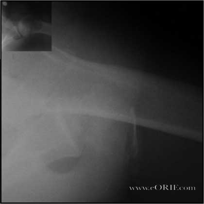 Anterior Inferior Shoulder Dislocation picture