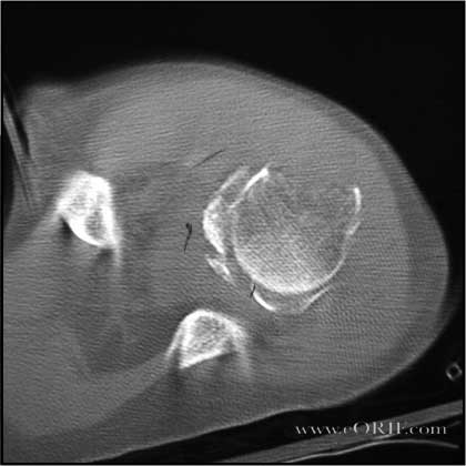 Anterior Inferior Shoulder Dislocation