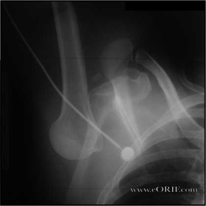 Inferior Dislocation picture