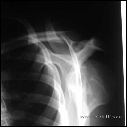 Posterior Shoulder Dislocation picture