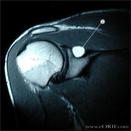     Ganglion cyst in the Spinoglenoid notch.