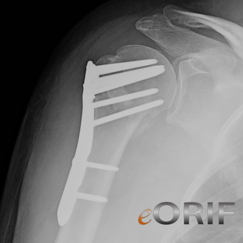 synthes proximal humerus plate xray