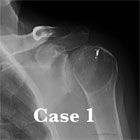 shoulder osteoarthritis xray