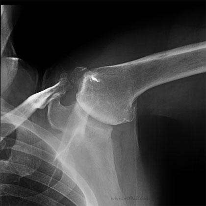 shoulder arthritis xray