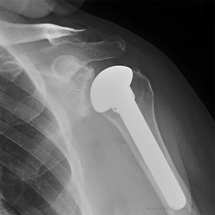 Total Shoulder Arthroplasty