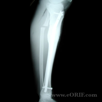 Tibial Shaft Fracture Malunion IM nail