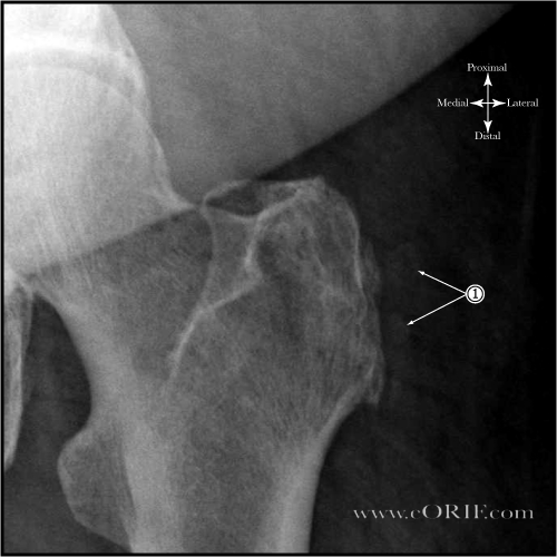 Trochanteric-Bursitis xray