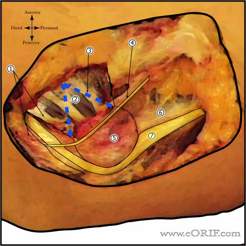 Ulnar Nerve Transposition anatomy