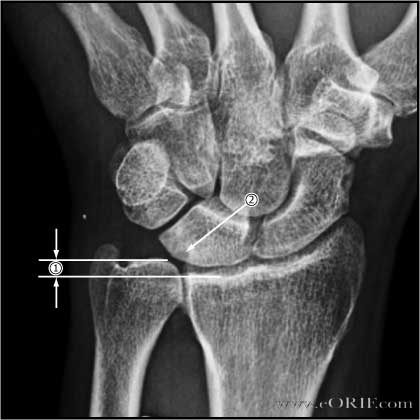 ulnar variance xray